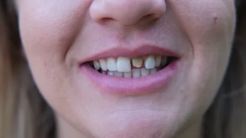 Woman's smile with a bad tooth. Teeth before treatment. Stock Footage 162335684