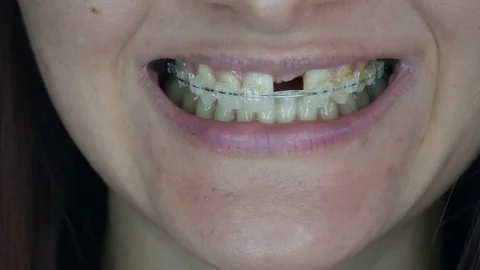 A woman's smile. Smile without upper left unit teeth. Video stock 125032011