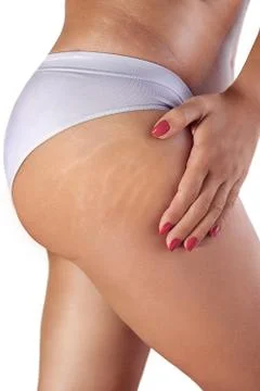 Womans thigh with stretch marks Stock Photos