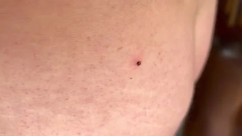 Wood tick bite Stock-Footage 219284803
