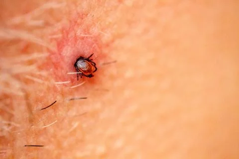 Wood Tick Bite Stock Photos