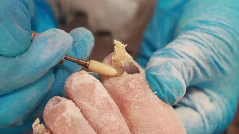 The work of a podiatrist is caring for toenails in an elderly person. nail Stock Footage 257757638