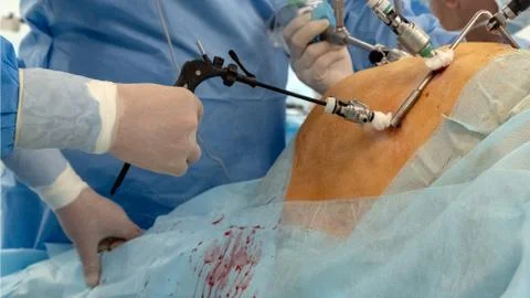 The work of surgeons using endo video of surgical instruments. Endoscopy. Lap Stock Photos