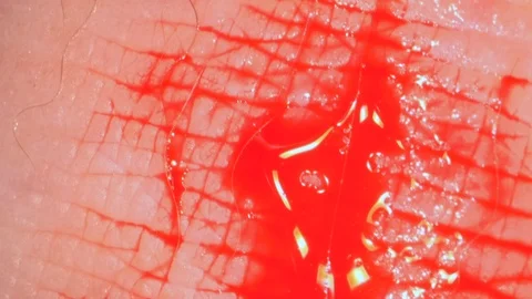 Wound and bleeding at leech bite. Close-up Stock Footage 123297891