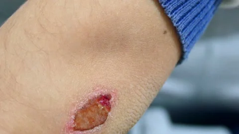 Wound in the arm and elbow as a result of falling, 動画素材 132217618