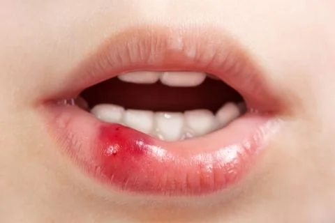 Wound child Stock Photos