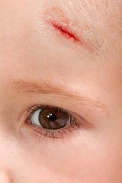 Wound child Stock Photos