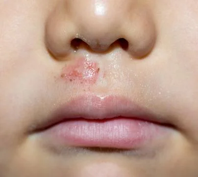 Wound on the child's face Stock Photos