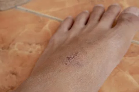 A wound that dries up due to scratching too hard because it itches. A close.. Stock Photos