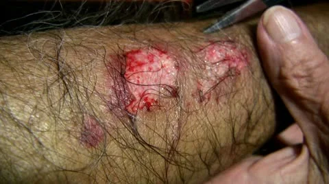 Wound Stock-Footage 9420530