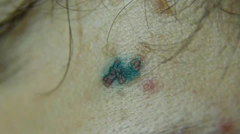 Wound Stock Footage 30597301