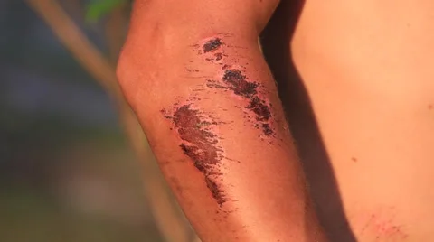 Wound on the hand of a man Stock Footage 37151652