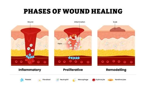 Wound healing process. Stages of the post-trauma repairing process. Inflamm.. Stock Illustration