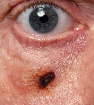 Wound on human cheek Stock Photos