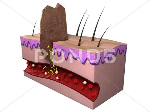 Wound infection, artwork Stock Illustration