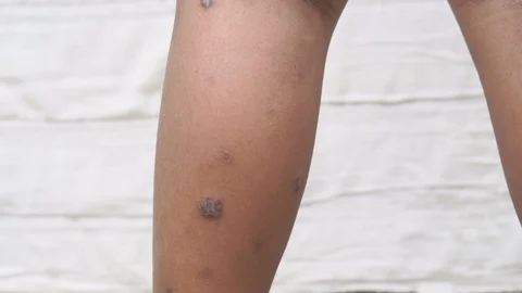 Wound from itching Video stock 101857184