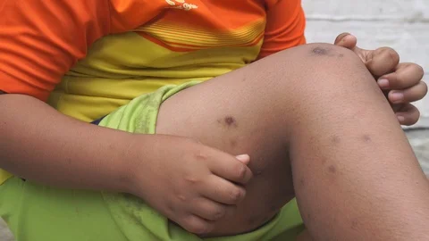 Wound from itching Video stock 101857214