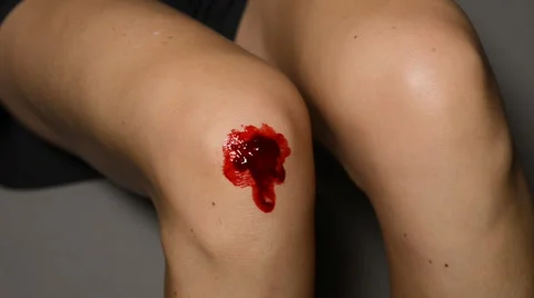 Wound on knee Video stock 68755300