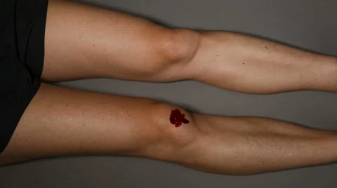 Wound on knee Stock Footage 68755405