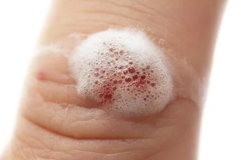 Wound peroxidized Stock Photos