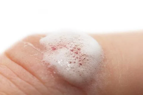 Wound peroxidized Stock Photos
