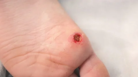 Wound of removed wart after laser removal on patient boy's foot, closeup view. Stock Footage 159885375