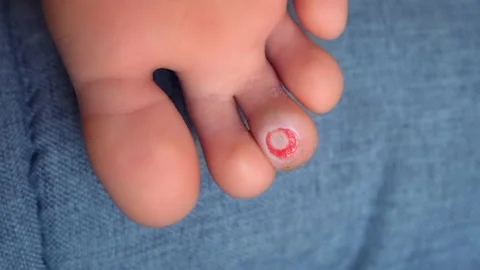 Wound of removed wart after laser removal on patient boy's foot, closeup view. Stock Footage 238987438