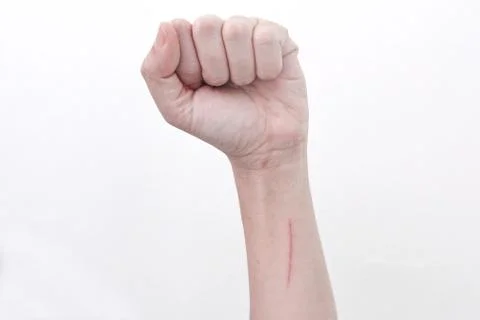 The wound from scratch on the arm is long. Stock Photos
