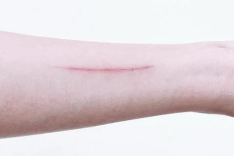 The wound from scratch on the arm is long. Stock Photos