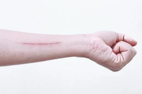 The wound from scratch on the arm is long. Stock Photos
