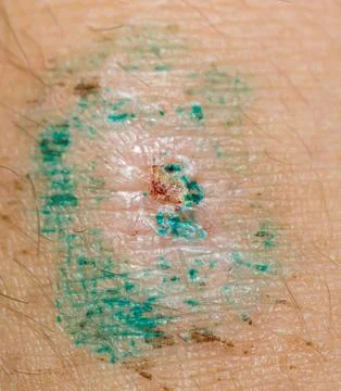 Wound on the skin of a macro Stock Photos