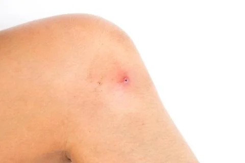 Wound on skin. Stock Photos