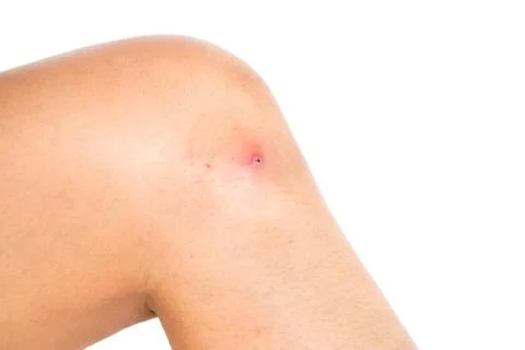 Wound on skin. Stock Photos