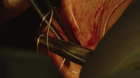 The wound is sutures Stock Footage 130793996