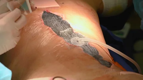 Wound vacuum technology during surgery Stock Footage 314908027