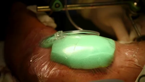 Wound vacuum technology during surgery Stock Footage 314908219