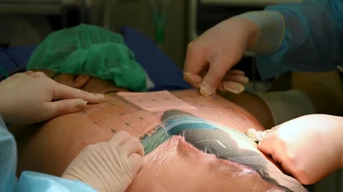 Wound vacuum technology during surgery Stock Footage 314908245