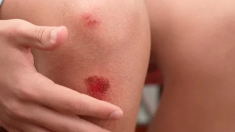 Wounded scraped red bleeding painful skin of leg Stock Footage 165934057