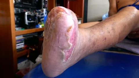 WoundRW Stock Footage 121500591