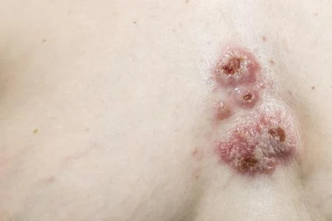 The wounds on the skin in the chest area. Pyoderma on woman body. Complicat.. Stock Photos