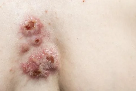 The wounds on the skin in the chest area. Pyoderma on woman body. Complicat.. Stock Photos