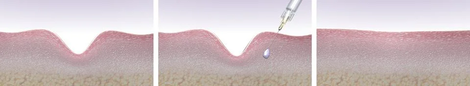 Wrinkle treatment injection 3d render Illustrazione stock