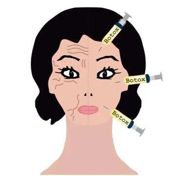 Wrinkles on one half of the face. Botox treatment. Botox injections Stock Illustration
