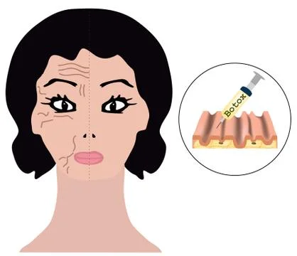 Wrinkles on one half of the face. Botox treatment. Botox injections Stock Illustration