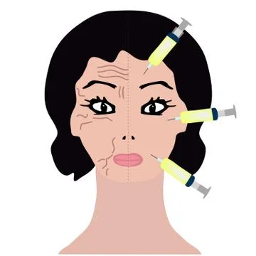 Wrinkles on one half of the face. Botox treatment. Botox injections Stock Illustration