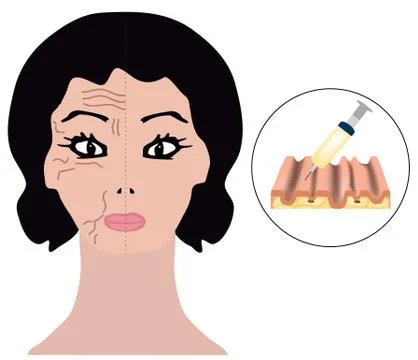 Wrinkles on one half of the face. Botox treatment. Botox injections Stock Illustration