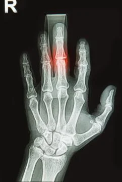 Wrist and hand  x-rays image show fracture  bone on finger splint Stock Illustration
