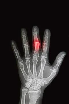Wrist and hand  x-rays image show fracture and dislocation bone Stock Photos