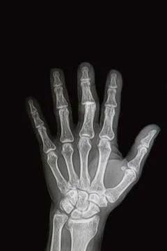 Wrist and hand  x-rays image show fracture and dislocation bone Stock Photos