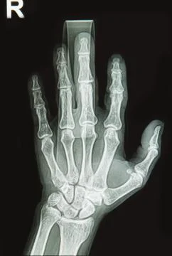 Wrist and hand  x-rays image show fracture  bone on finger splint Foto stock